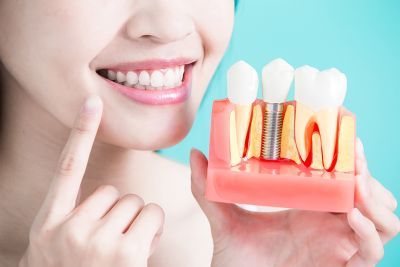 Chăm sóc răng miệng sau khi cấy ghép implant