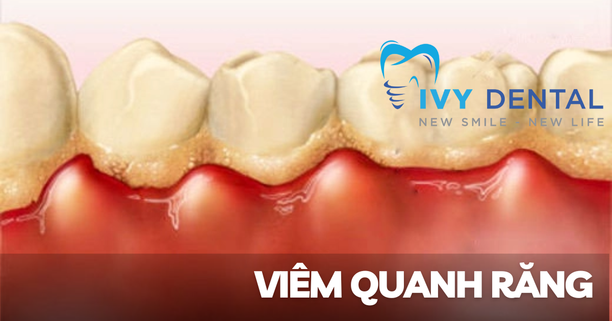 Viêm quanh răng Nguyên nhân triệu chứng và cách điều trị hiệu quả tại Nha khoa Ivy - Bình Thạnh