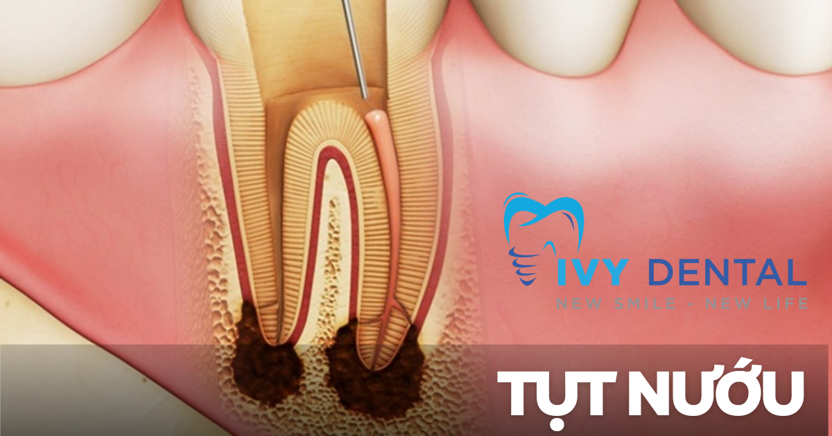 Viêm tủy răng Nguyên nhân triệu chứng và cách điều trị hiệu quả Nha khoa Ivy - Bình Thạnh
