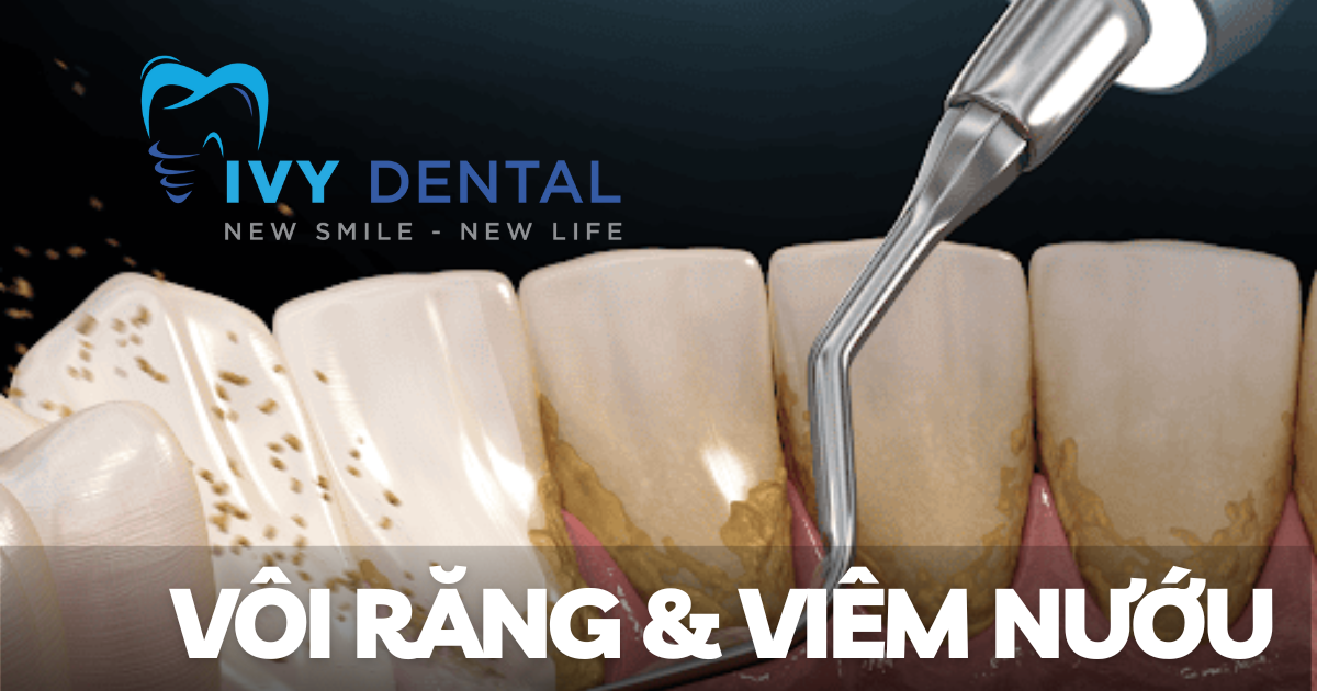 Vôi răng và viêm nướu Nguyên nhân triệu chứng và cách điều trị hiệu quả Nha khoa Ivy - Bình Thạnh