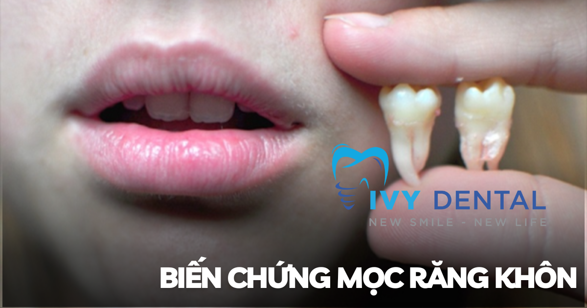 nha khoa ivy - Biến chứng mọc răng khôn Nguyên nhân triệu chứng và cách điều trị hiệu quả