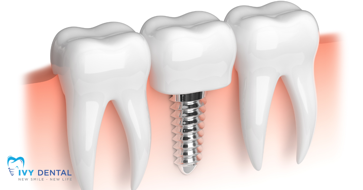 nha khoa ivy - Chi Phí Cấy Ghép Implant Là Bao Nhiêu 