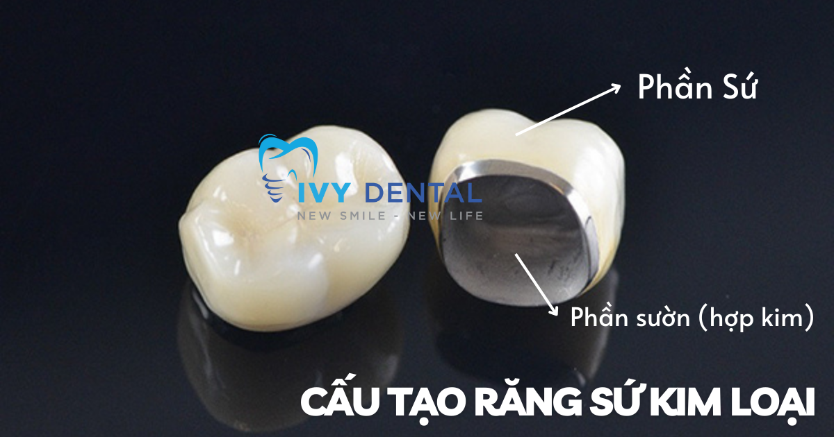 nha khoa ivy - Cấu tạo răng sứ kim loại và những điều cần biết