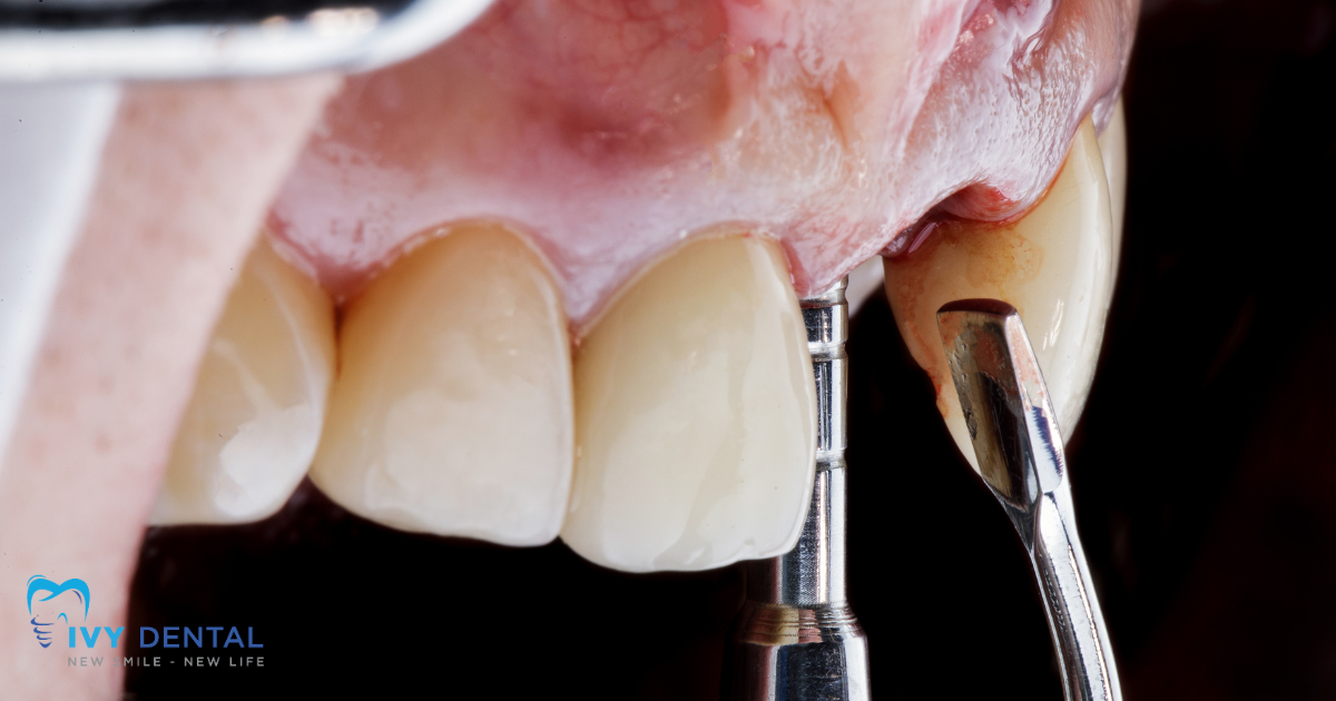 nha khoa ivy - Dịch Vụ Cấy Ghép Implant Chuyên Nghiệp Tại Nha Khoa Ivy