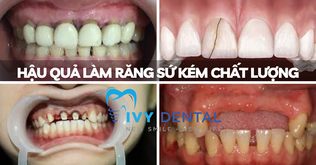 nha khoa ivy - Hậu quả làm răng sứ kém chất lượng