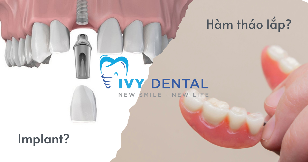 nha khoa ivy - Implant Hay Hàm Giả Tháo Lắp Lựa Chọn Nào Tối Ưu Hơn
