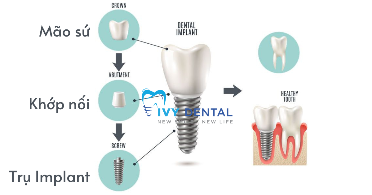 nha khoa ivy - Implant là gì Cấu tạo và ưu điểm vượt trội