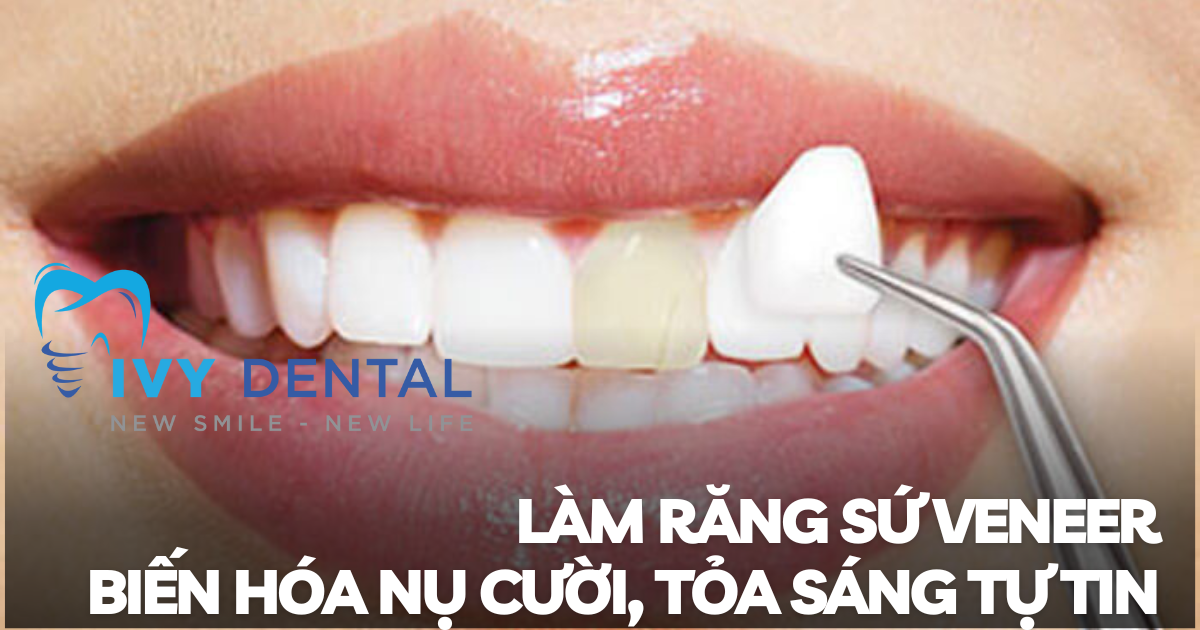 nha khoa ivy - Làm răng sứ Veneer Biến hóa nụ cười tỏa sáng tự tin