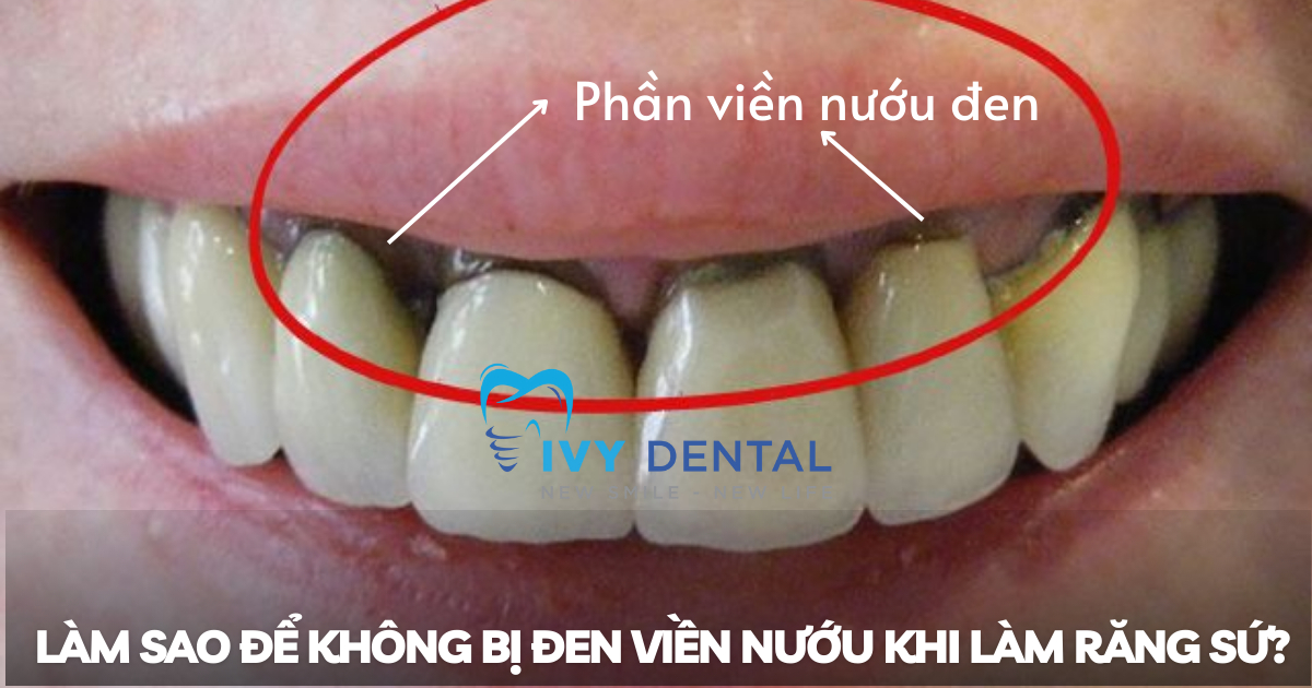 nha khoa ivy - Làm sao để không bị đen viền nướu khi làm răng sứ-
