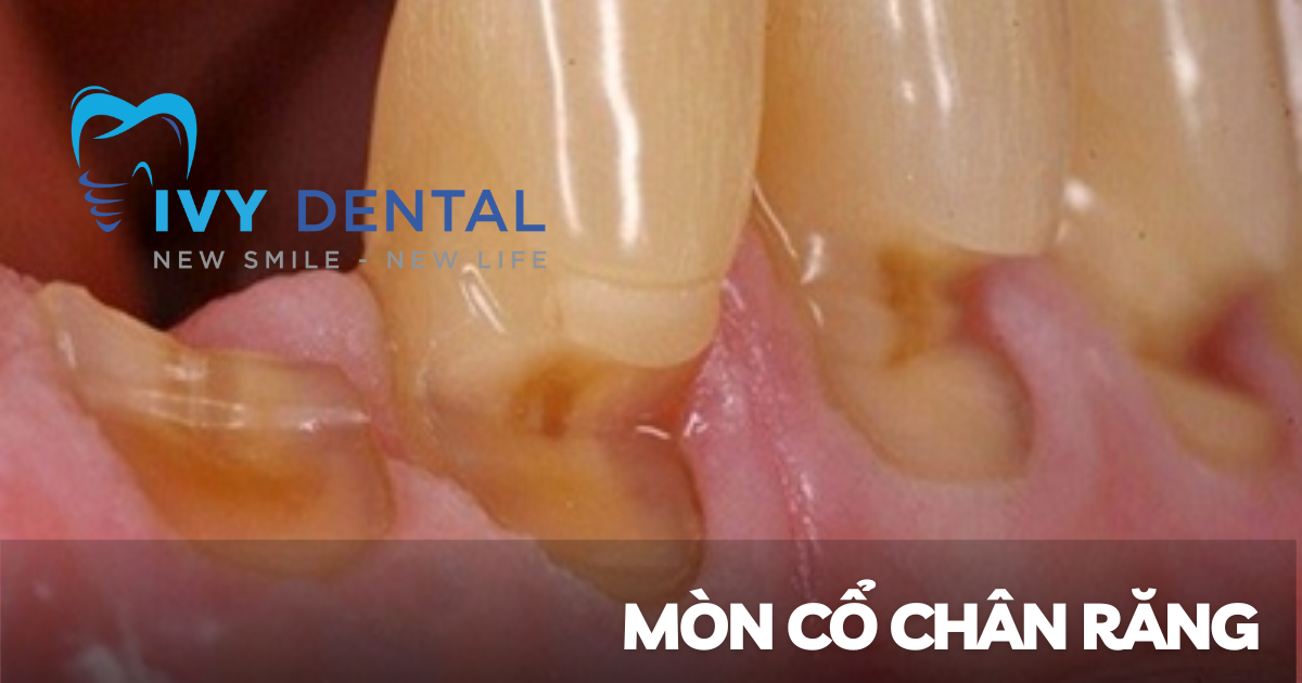 nha khoa ivy - Mòn cổ chân răng Nguyên nhân triệu chứng và cách điều trị hiệu quả