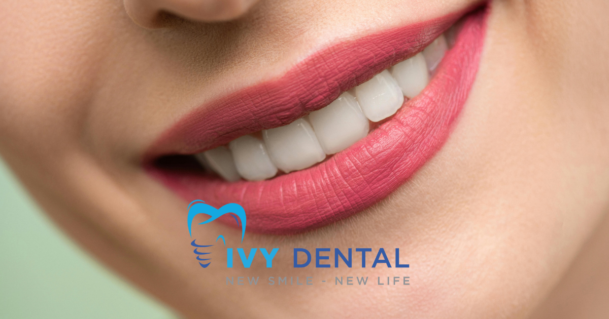 nha khoa ivy - Mặt dán sứ Veneer Giải pháp thẩm mỹ tối ưu cho nụ cười hoàn hảo