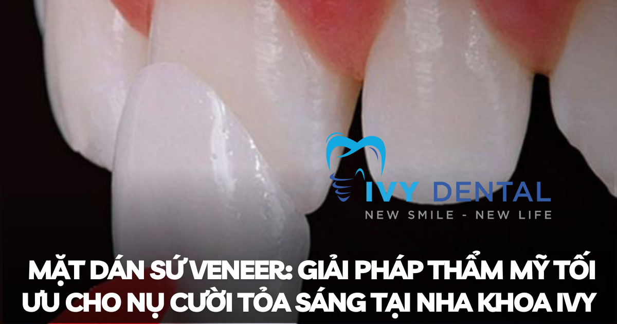 nha khoa ivy - Mặt dán sứ Veneer Giải pháp thẩm mỹ tối ưu cho nụ cười tỏa sáng tại Nha khoa Ivy