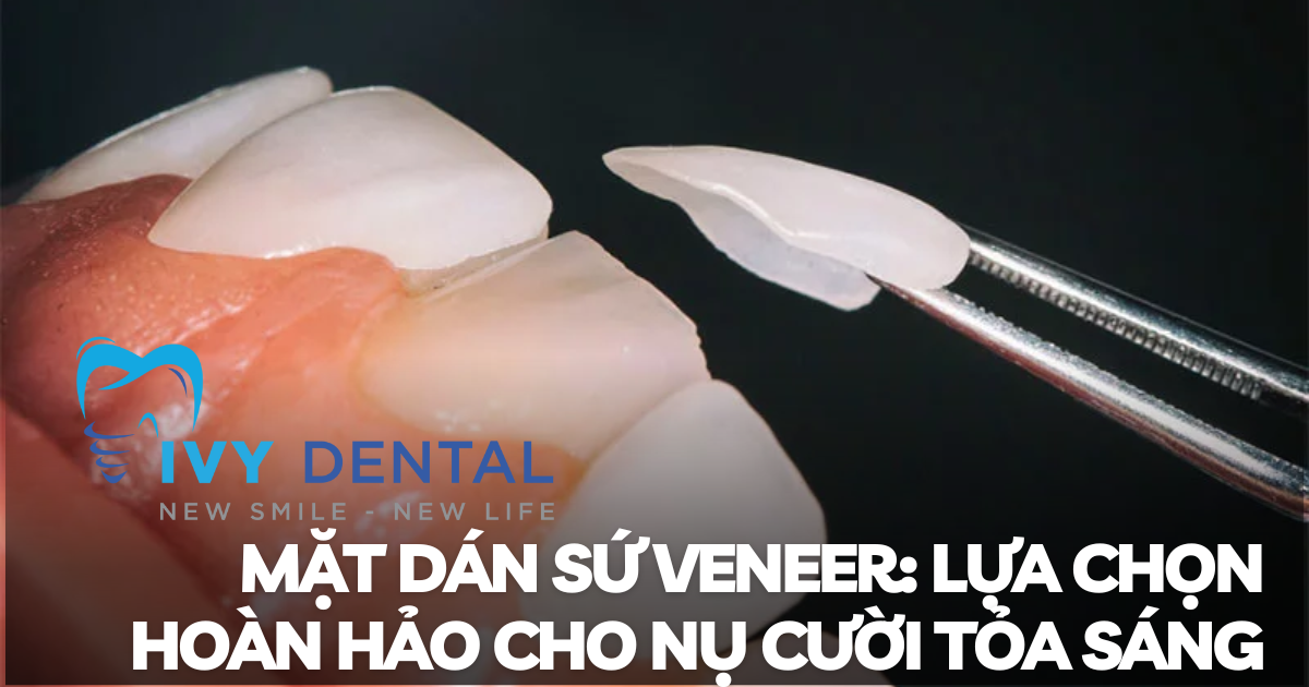 nha khoa ivy - Mặt dán sứ Veneer Lựa chọn hoàn hảo cho nụ cười tỏa sáng