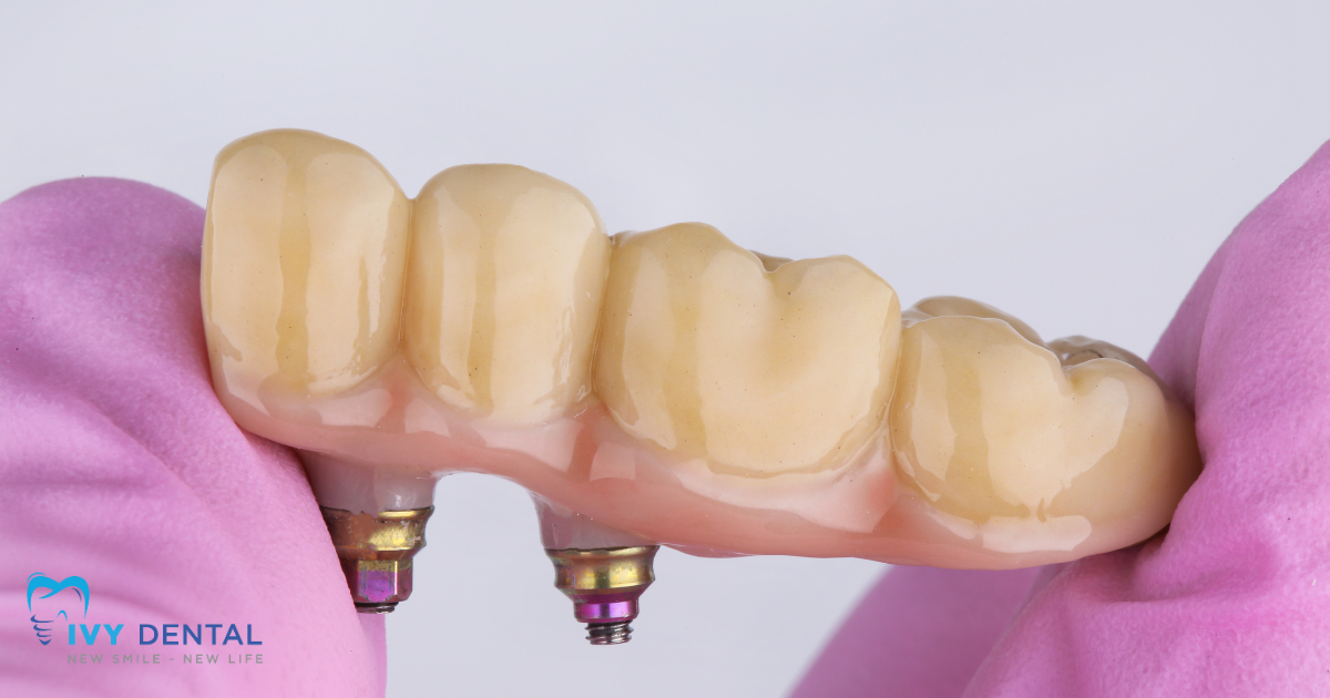 nha khoa ivy - Những Trường Hợp Chống Chỉ Định Cấy Ghép Implant