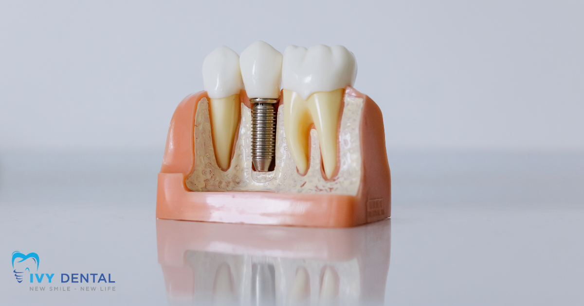 nha khoa ivy - các loại implant phổ biến hiện nay