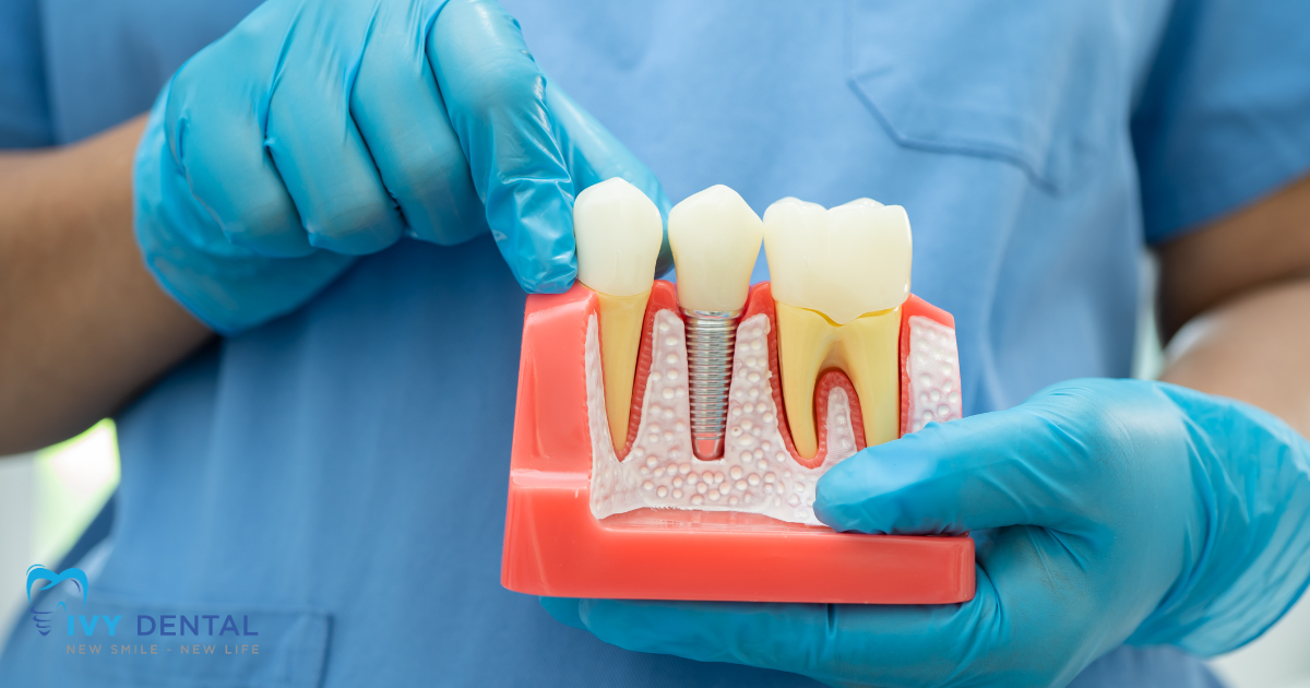 nha khoa ivy Tuổi Thọ Của Implant Là Bao Nhiêu Năm