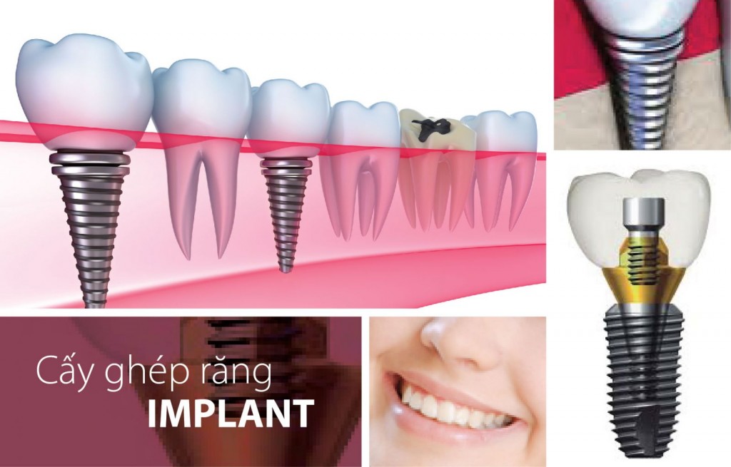 trung-tam-cay-ghep-implant-1