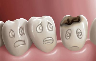 Những lệch lạc thường thấy nơi răng trẻ em và chỉnh nha phòng ngừa