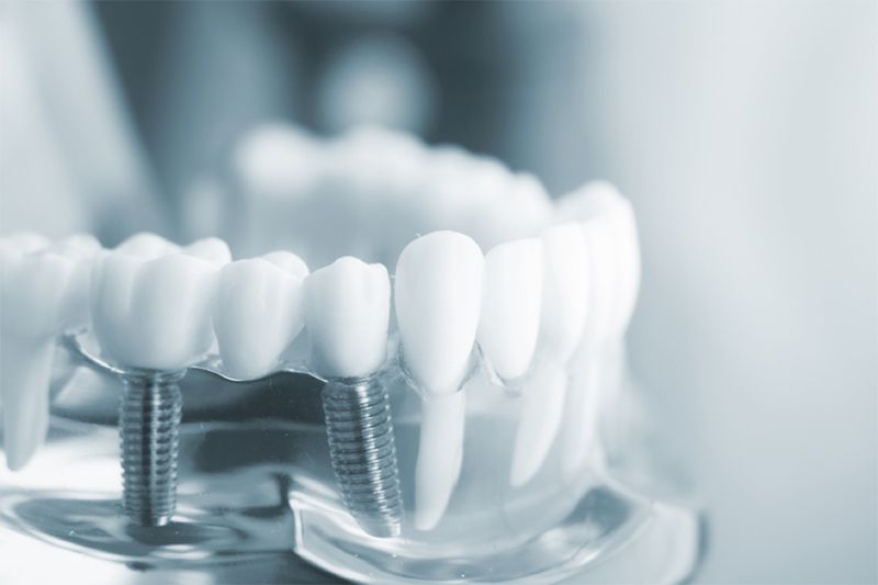 Cấy Ghép Implant Có Nhưng Ưu Điểm Gì? Tại Sao Ngày Càng Có Nhiều Người Tin Dùng Phương Pháp Này