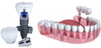 Cập Nhật Bảng Giá Cấy Ghép Implant Mới Nhất Năm 2021