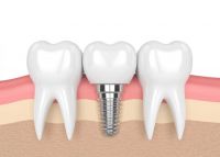 Quy Trình Cấy Ghép Implant