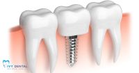 Chi Phí Cấy Ghép Implant Là Bao Nhiêu? | Nha Khoa Ivy - Bình Thạnh