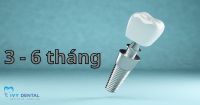 Thời Gian Cấy Ghép Implant Bao Lâu Thì Hoàn Thành? | Nha Khoa Ivy - Bình Thạnh