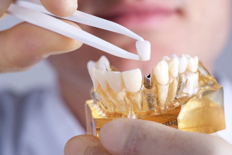 5 Lợi Ích Bất Ngờ Từ Cấy Ghép Implant