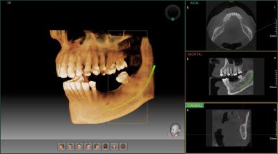 Trồng răng implant tại NHA KHOA IYY