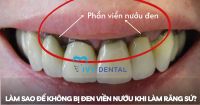 Răng Sứ | Làm sao để không bị đen viền nướu khi làm răng sứ? | Nha Khoa Ivy - Bình Thạnh