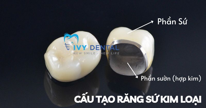 Răng Sứ | Cấu tạo răng sứ kim loại và những điều cần biết | Nha Khoa Ivy - Bình Thạnh