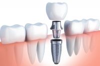 Ưu điểm của implant