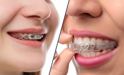 Niềng răng thẩm mỹ – Giải pháp mang lại nụ cười đẹp hoàn hảo