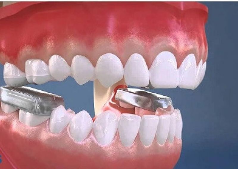 Vì sao cần nâng khớp cắn trong niềng răng?