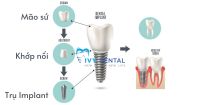 Implant là gì? Cấu tạo và ưu điểm vượt trội? | Nha khoa Ivy - Bình Thạnh