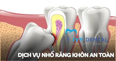 Nhổ răng | Dịch Vụ Nhổ Răng Khôn An Toàn Tại Nha Khoa Ivy – Bình Thạnh, TP. Hồ Chí Minh