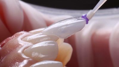 Mặt dán sứ veneer – Phục hình răng đẹp hoàn hảo, bảo tồn răng thật tối đa