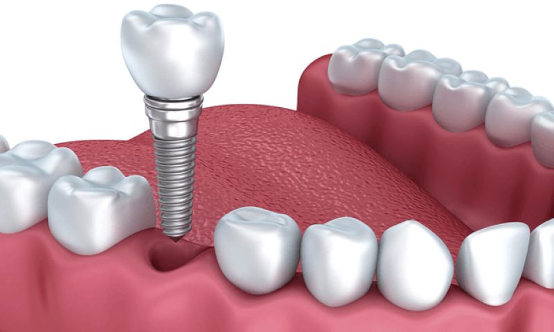 Ưu Điểm Của Cấy Ghép Implant