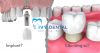 Implant Hay Cầu Răng Sứ: Lựa Chọn Nào Phù Hợp Với Bạn? | Nha Khoa Ivy - Bình Thạnh