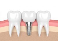 Cấu tạo của implant