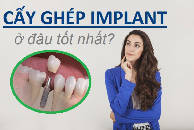 Chọn Trung Tâm Cấy Ghép Implant Như Thế Nào?