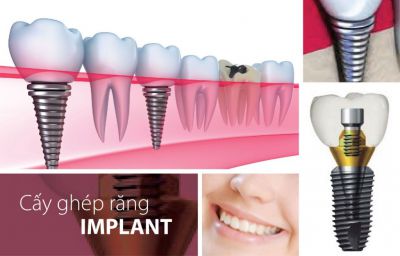 3 Điều Cần Lưu Ý Khi Thực Hiện Cấy Ghép Răng Implant