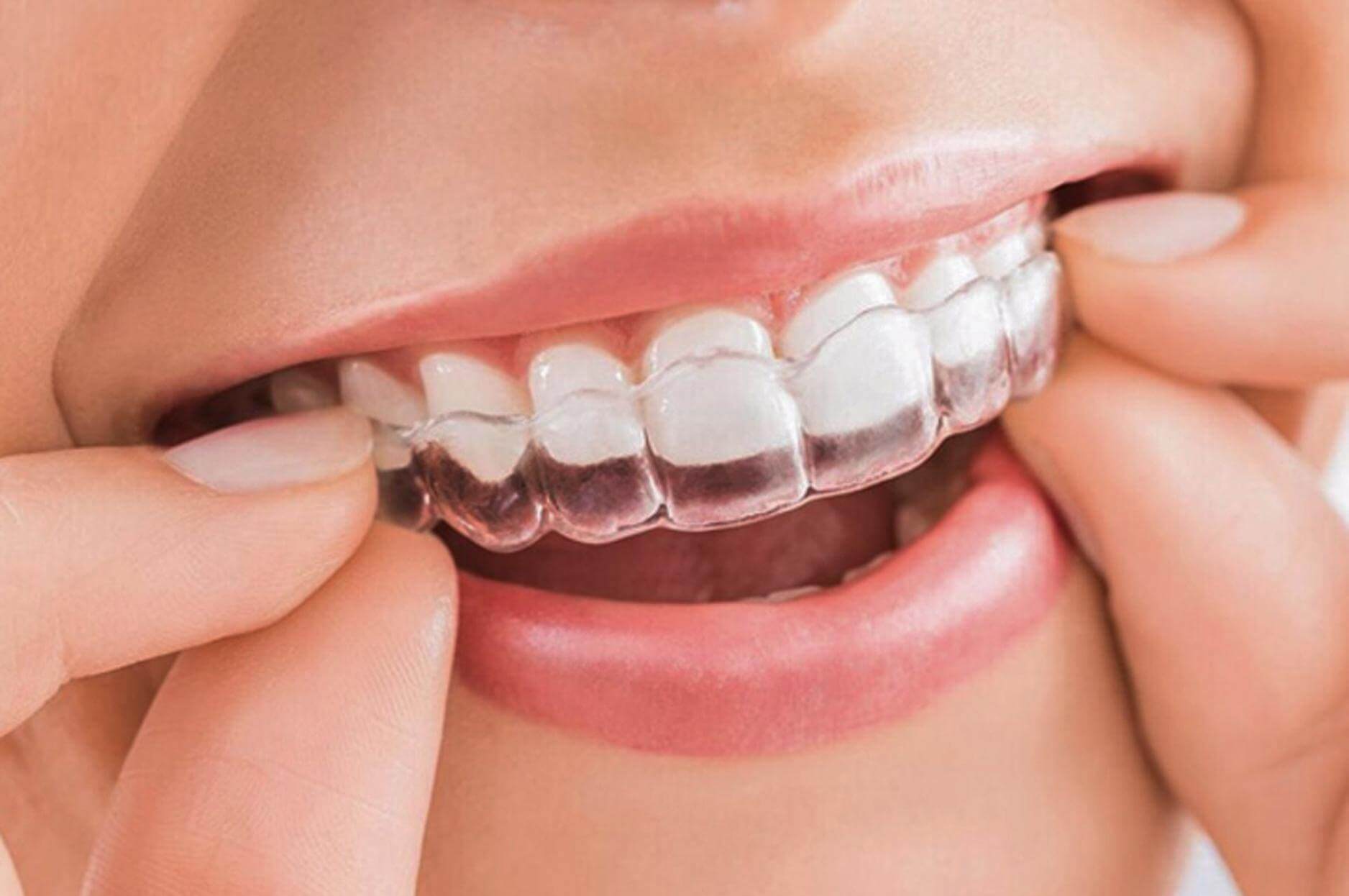 Invisalign