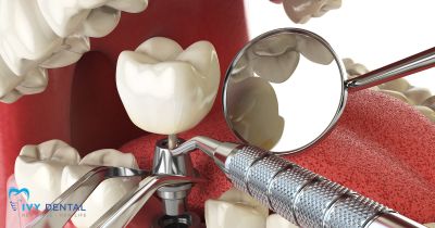 Quy trình cấy ghép Implant tại Nha khoa Ivy: An toàn, hiệu quả, không đau | Nha khoa Ivy – Bình Thạnh