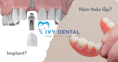 Implant Hay Hàm Giả Tháo Lắp: Lựa Chọn Nào Tối Ưu Hơn? | Nha Khoa Ivy – Bình Thạnh