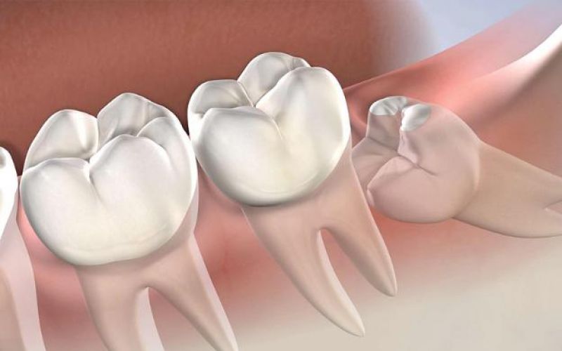 Nhận biết và xử lý răng khôn mọc lệch