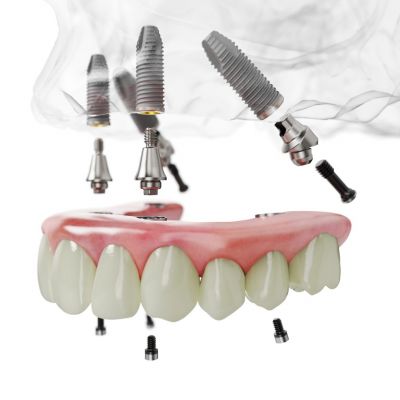 Phương Pháp Làm Răng Giả Implant All-on-4