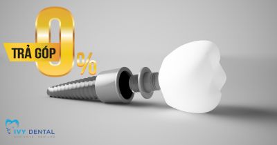 Cấy Ghép Implant Trả Góp Tại Nha Khoa Ivy: Linh Hoạt & Tiện Lợi | Nha khoa Ivy – Bình Thạnh
