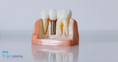 Các loại implant phổ biến trên thị trường hiện nay | Nha khoa Ivy – Bình Thạnh