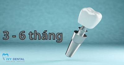 Thời Gian Cấy Ghép Implant Bao Lâu Thì Hoàn Thành? | Nha Khoa Ivy – Bình Thạnh